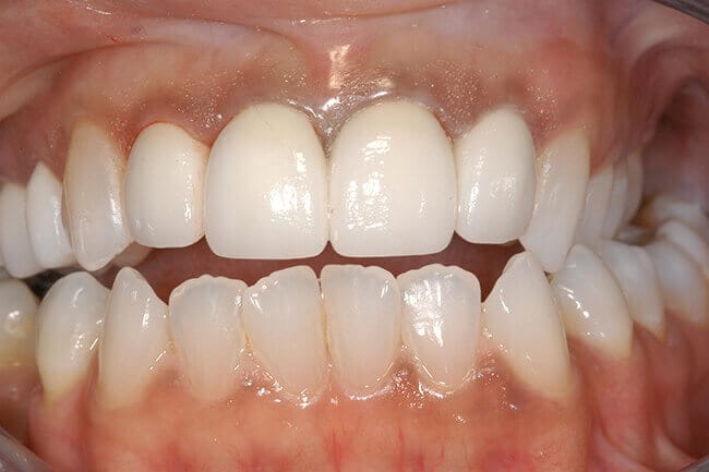 Flawlessly repaired dental restoration
