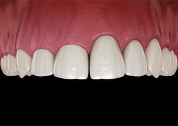 A digital image of an uneven gum line that needs crown lengthening