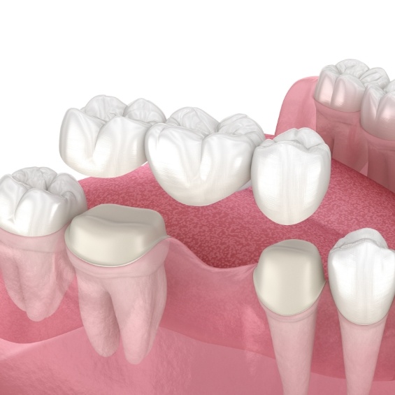 illustration of traditional dental bridge in Simpsonville