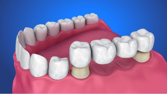 illustration of implant bridge in Simpsonville