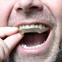 Closeup of a man wearing a mouthguard to prevent dental emergencies