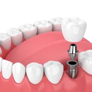 3D illustration of a crown, abutment, and implant with the rest of the smile