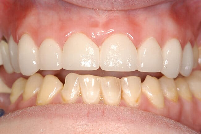 Perfectly repaired top teeth