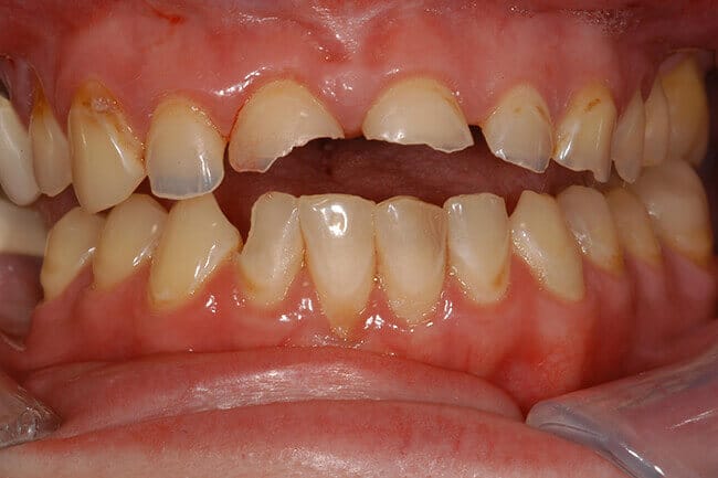 Broken top front teeth