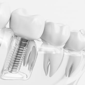 Single dental implant and crown model against white background