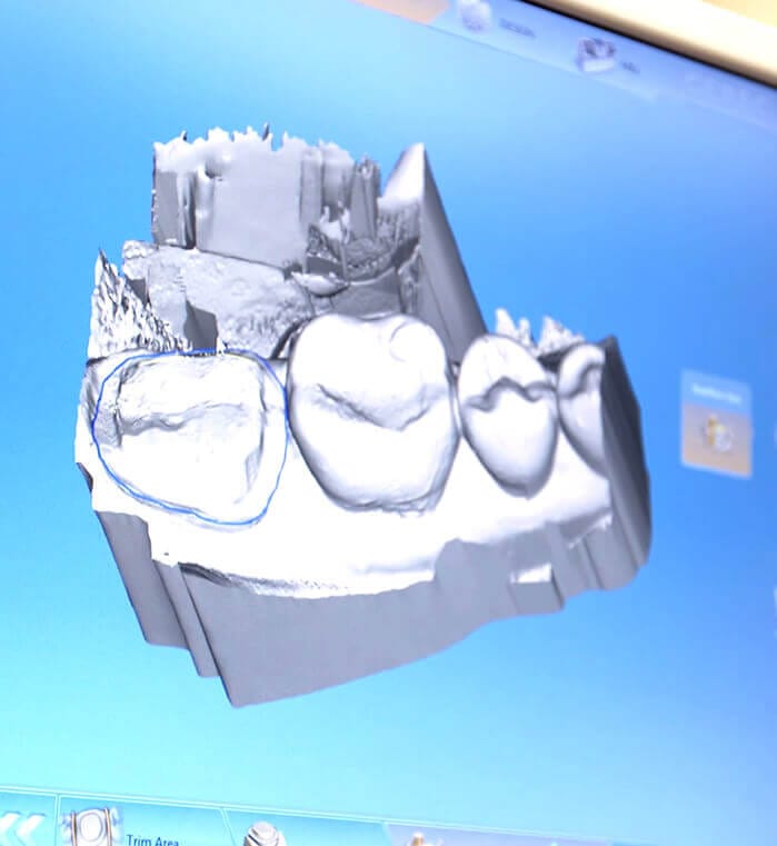 CEREC digital dental crown design on computer monitor