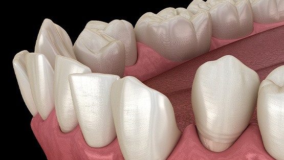 Illustration of gapped teeth