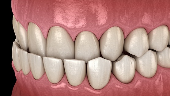 Illustration of an underbite