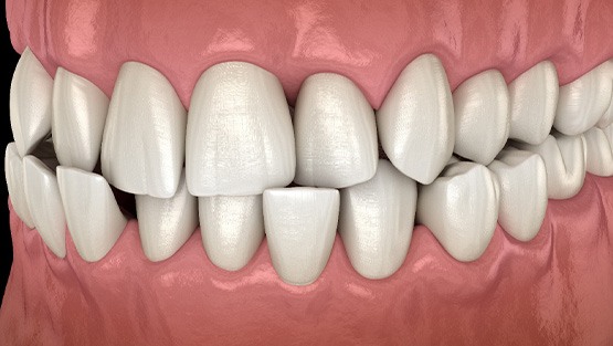 Illustration of a crossbite