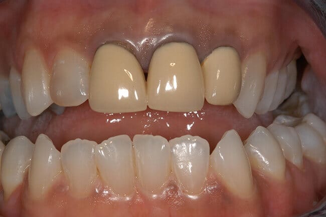 Damaged dental restoration on top teeth