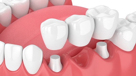 Exploded illustration of traditional dental bridge