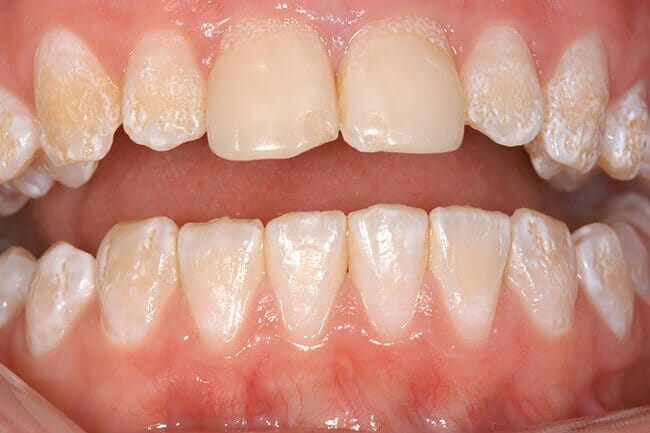 Worn teeth prior to dental restoration