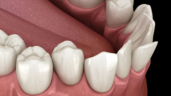 a patient putting aligners in her mouth at a dental office