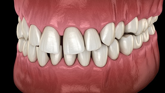 a computer illustration showing crowded teeth