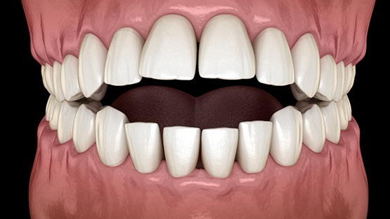 a computer illustration showing misspaced teeth