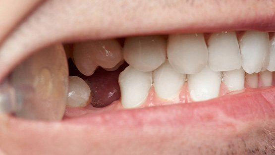 Closeup of a missing tooth