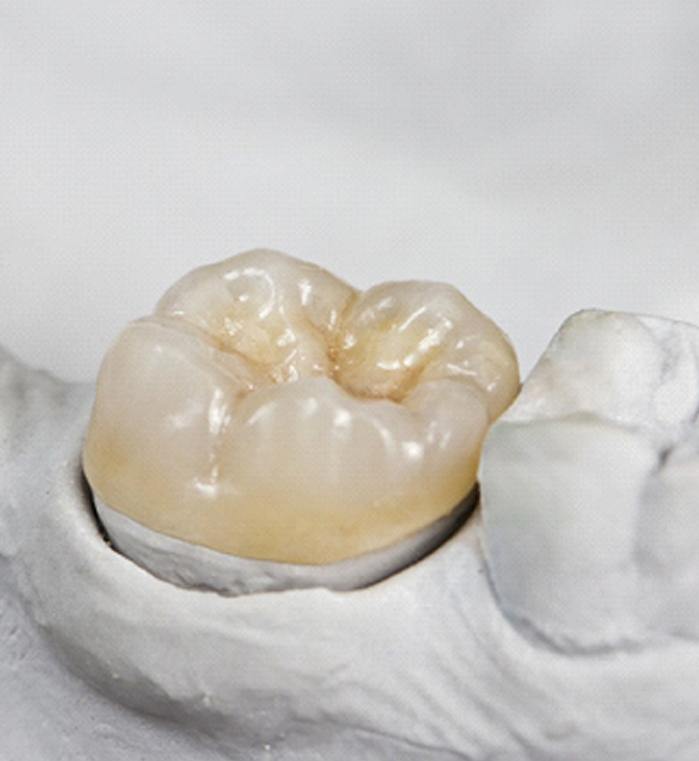 A dental crown sitting in a mold.