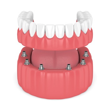 Model of implant-supported denture 