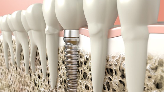 Digital illustration of a dental implant