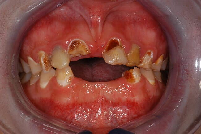 Decayed and damaged smile with several missing teeth