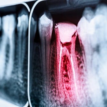 X-ray diagram of bad toothache symbolized with red