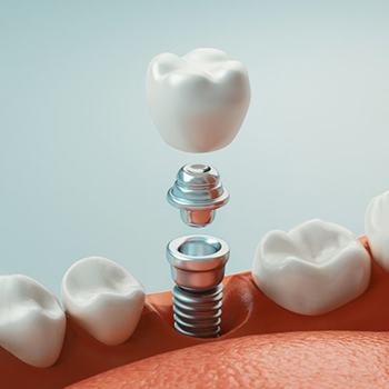 a 3 D illustration of a single dental implant
