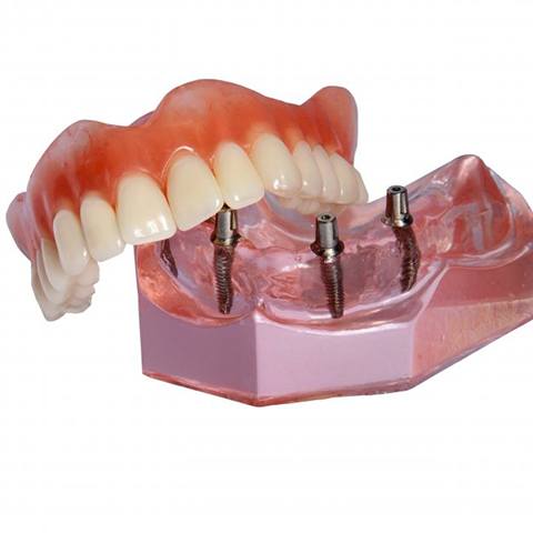 Model of implant dentures and implants