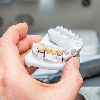 Dental implant bridge on model