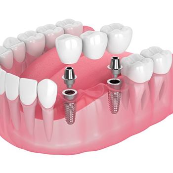 a 3 D illustration of a dental bridge on implants