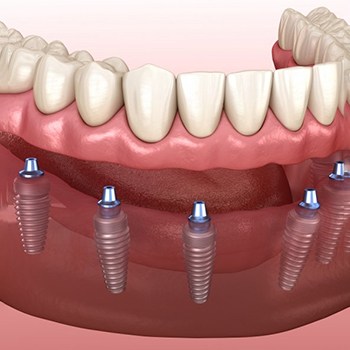 a 3 D illustration of dentures connecting to dental implants