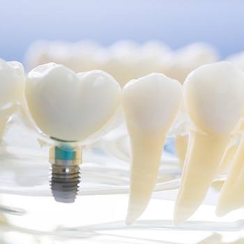 Model jaw with teeth and dental implants in Simpsonville 