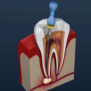 Model of root canal procedure