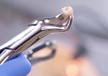 A dental professional holding an extracted tooth with a pair of dental pliers