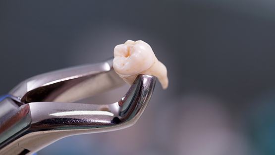 Dental forceps holding a patient’s extracted tooth