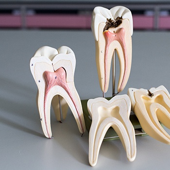 tooth models showing decay