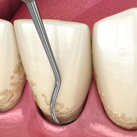 Illustration of scaling and root planing process
