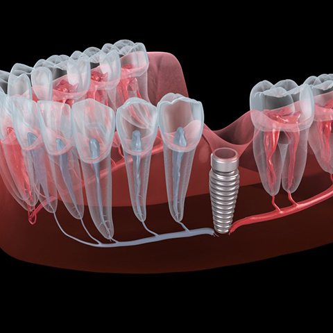 Illustration of dental implant in gum tissue