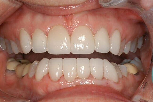 Smile with gaps closed between teeth