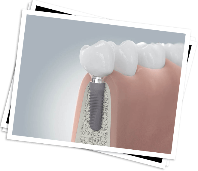 3D animated rendering of implant supported replacement tooth