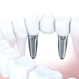Illustration of implant-supported dental bridge against white background