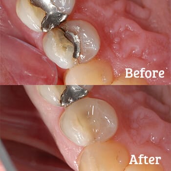 Teeth with metal free dental restorations replacing metal fillings