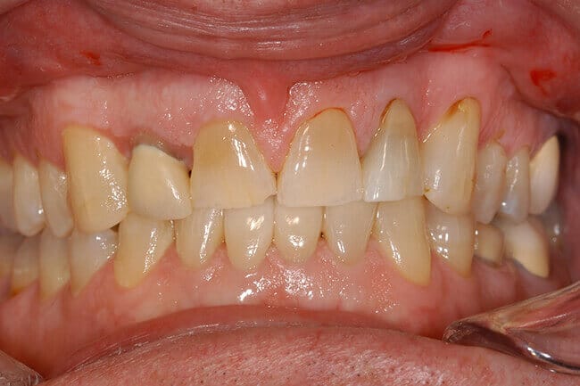 Decayed and discolored smile before dental treatment