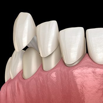 A digital view of veneers being placed over natural teeth in Simpsonville