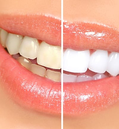 Close up of smile before and after teeth whitening in Powdersville