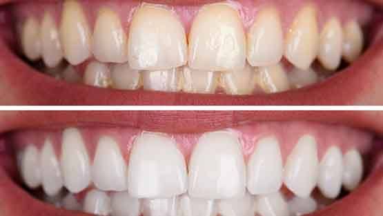 a before-and-after photo showing teeth whitening