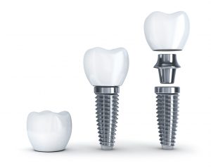 Get the dental implants in Piedmont you need all in one practice! 