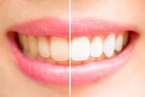 White teeth compared to discolored teeth.