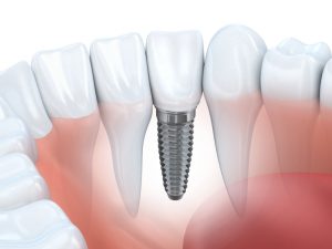 close-up of a dental implant