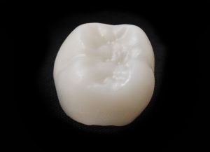 A white, ceramic dental crown 