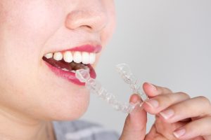 woman smiling inserting Invisalign tray